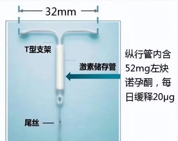 守护子宫健康，宫腔镜下节育环缝合固定了解一下⇒