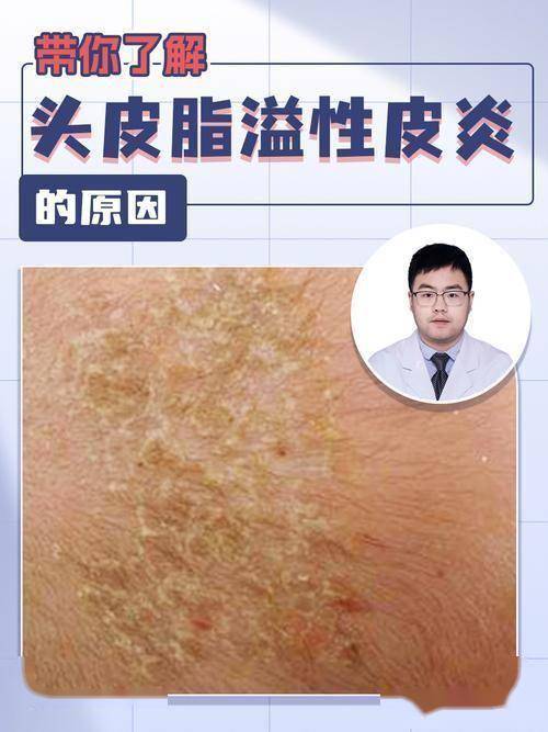 摆脱脂溢性皮炎困扰，专家教你这样做 告别脂溢性皮炎困扰