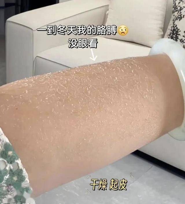 手脚干裂、皮肤起纹别乱养！做好疏肝健脾温阳，10天养回细腻状态