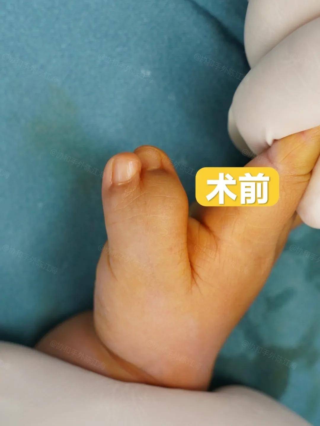 原创            多指│案例54《宝宝多指的日子，我们很愧疚，逛超市都不敢》