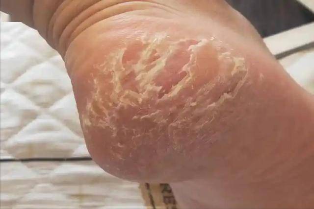 秋冬脚后跟开裂，或是疾病信号，4种情况不要忽视！不是皮肤干燥