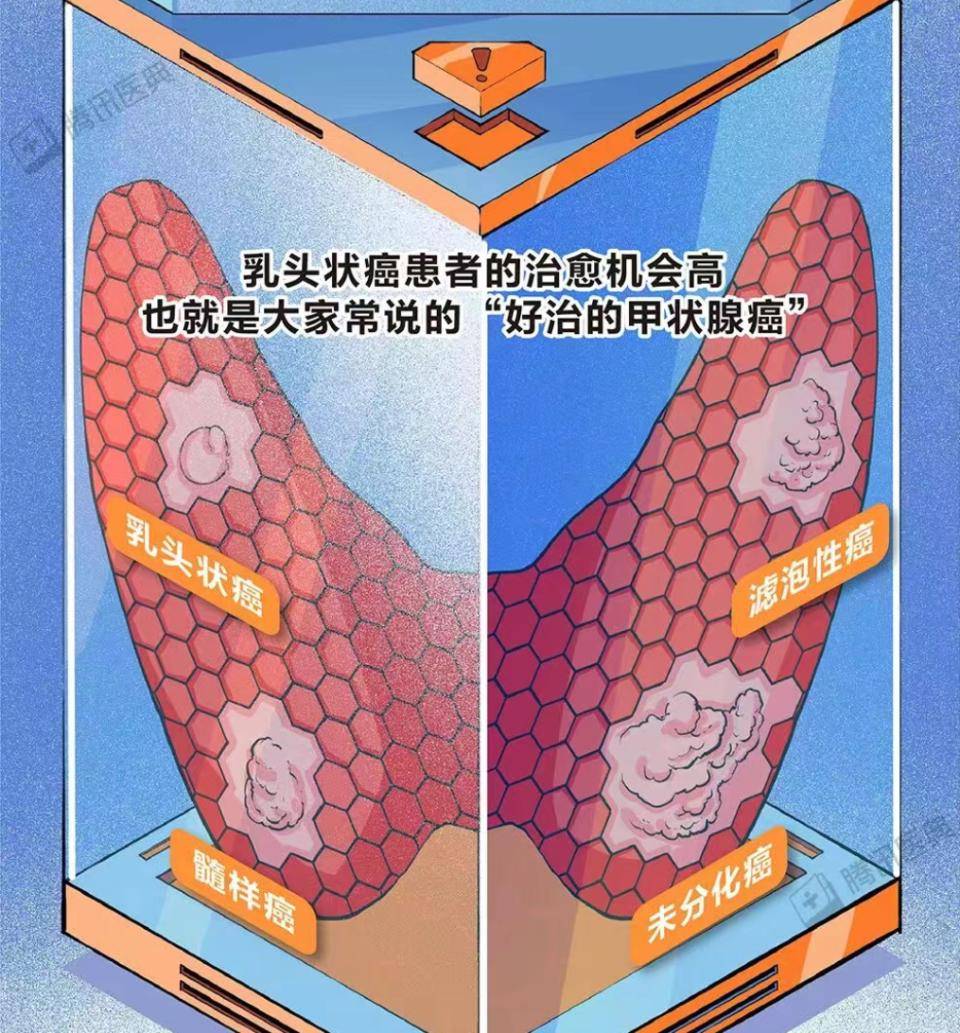 一家4人同患甲状腺癌，医生提醒