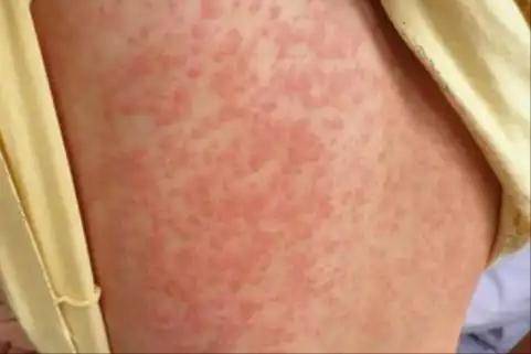 越来越多的人患湿疹？医生告诫：家里久放的5物，可能是“凶手”