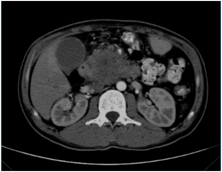 37岁青年胰腺癌绝境重生，纳米刀技术点燃生命希望