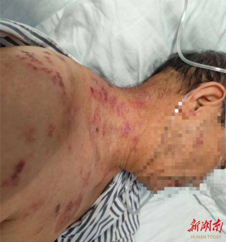 头痛、肩颈痛+小水疱，警惕“缠腰龙”！医生：发病72小时内治疗有效防后遗症