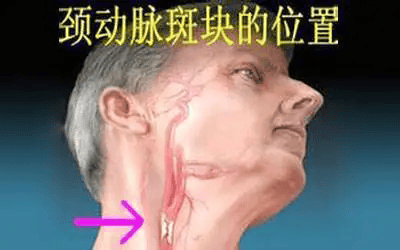 冬季心脑血管问题高发，请高度重视，9件事做好预防！