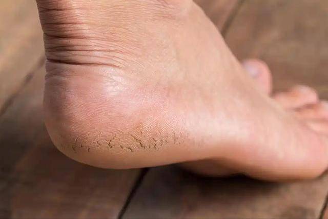 脚后跟开裂，或是大病的信号！若出现这3种情况，千万不能拖了！