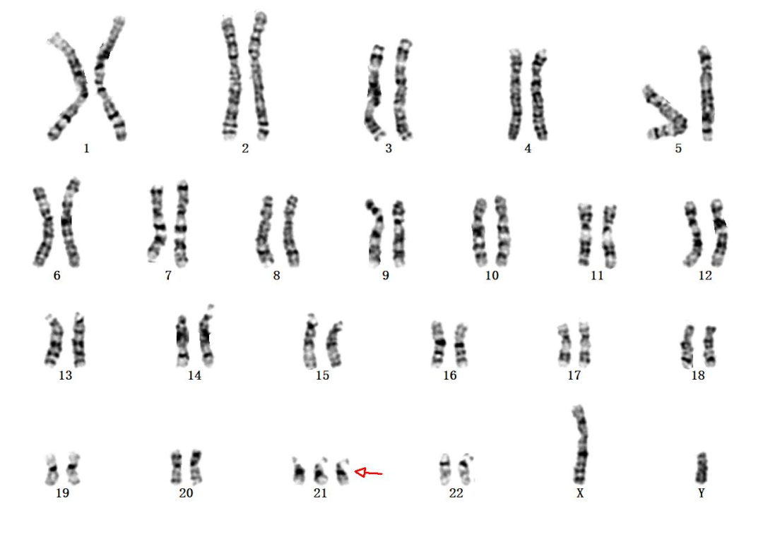【健康科普】唐氏综合征：一种不可忽视的染色体疾病