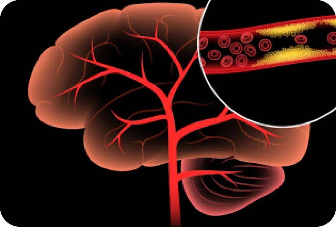 血小板数值低？入冬要警惕！掌握预防应急措施，远离脑出血风险