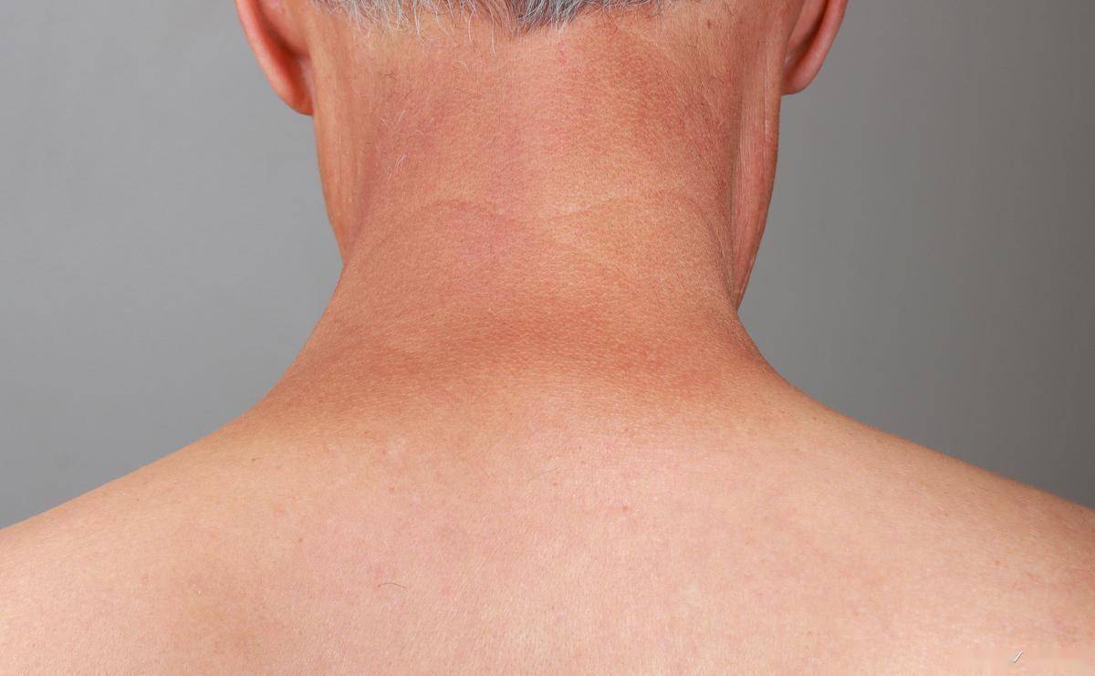 原创            高血压患者脖子粗，心血管病风险高，新疆学者研究