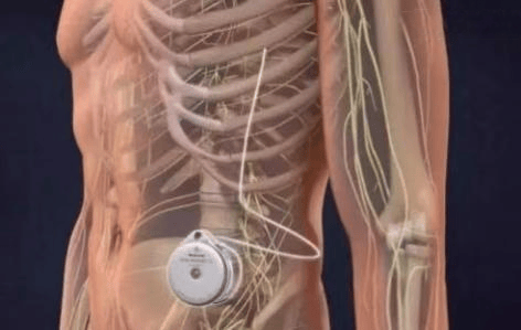 高效镇痛，改善生活——鞘内吗啡泵植入术治疗顽固性癌痛