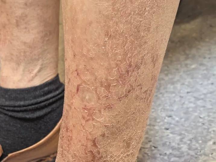 “腿上像糊了鱼鳞，晚上痒得钻心！”降温后多人中招，医生提醒