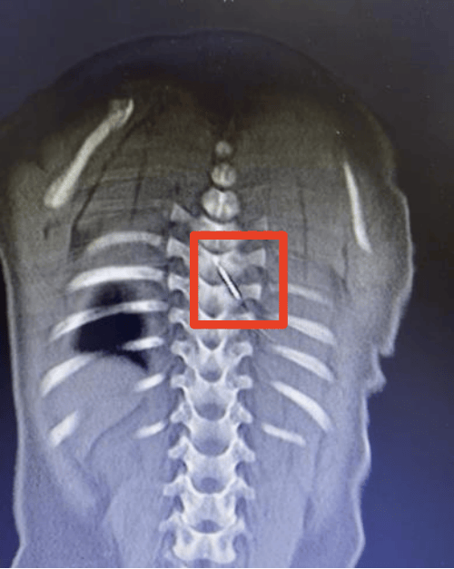 约3厘米长缝衣针扎入9月龄宝宝脊柱 ，医生：这是我见过最危险的异物损伤之一！