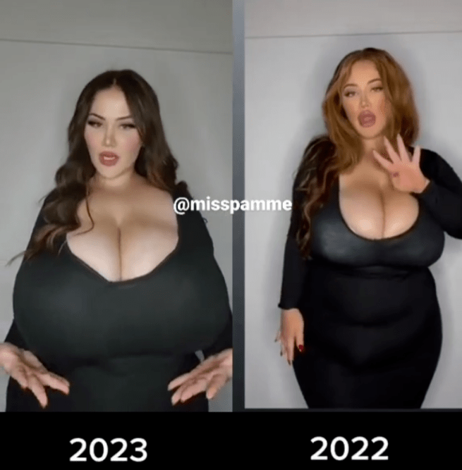 原创            女子双胸重约25斤，确诊“巨乳症”！什么是巨乳症？怎么治疗？