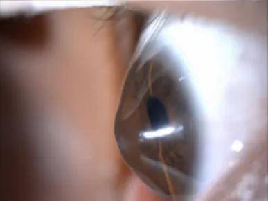 12岁娃换2副眼镜仍看不清！医生揭穿：这不是近视…