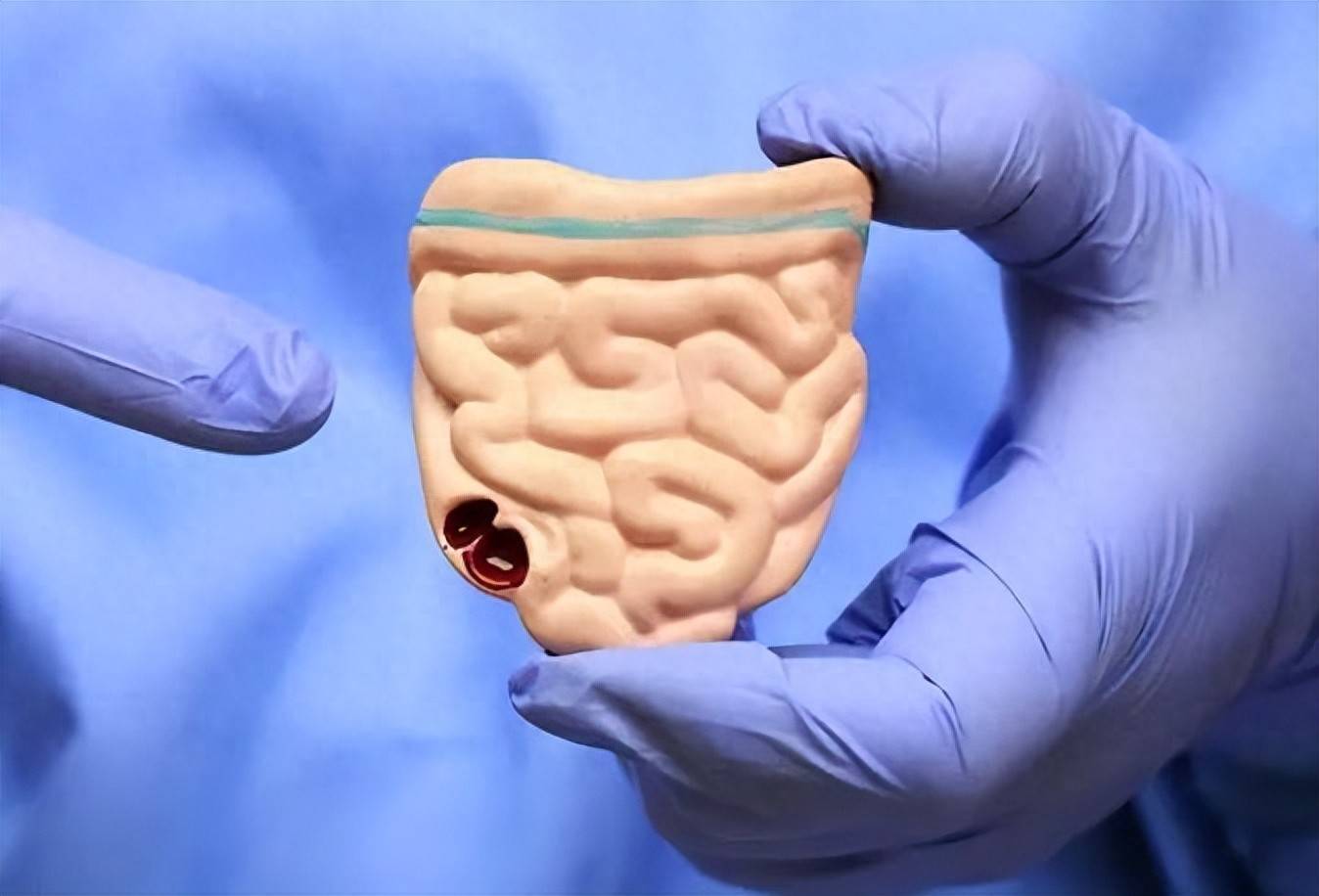 原创            肠癌不是大病，但别让它偷走你的生命，3类症状别忽视，及时就医