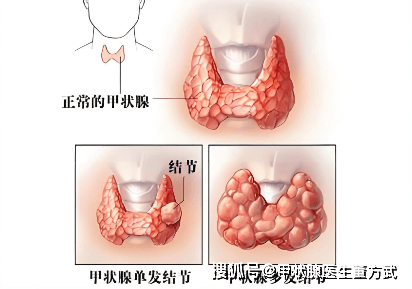 有甲状腺结节的朋友建议存下来，医生总结的这10件小事，坚持做有好处！