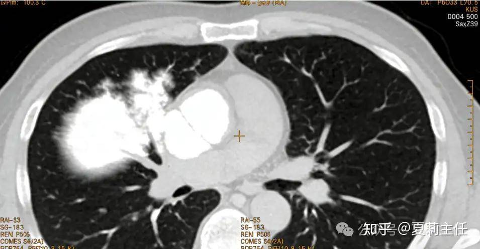 肺癌不传染，可家人确诊后，你的患癌风险可能会增加一半