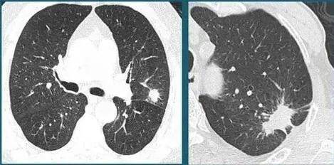 甲流后发现肺结节，用它煮水，止咳化痰、祛湿散结！