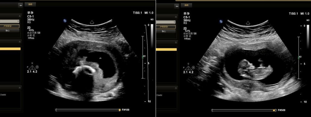 “上环”就稳了？——警惕带环妊娠