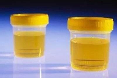 男性尿液发黄，邯郸燕赵刘主任解析到底是怎么一回事？