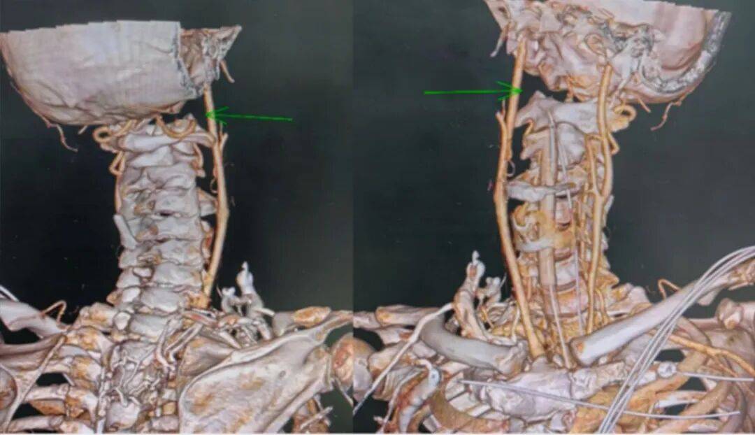 “头颈分离”的他活下来了，多亏广州医生的一个“反常规”决定