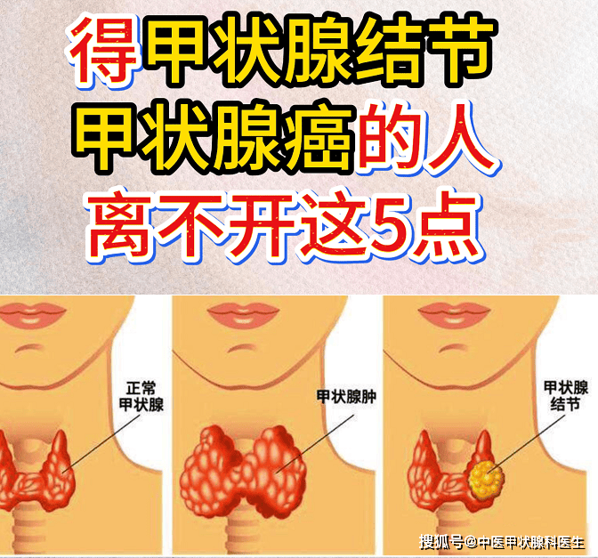 人不会无缘无故得甲状腺癌！得甲状腺结节的人，离不开这5点！预防甲状腺结节甲状腺癌