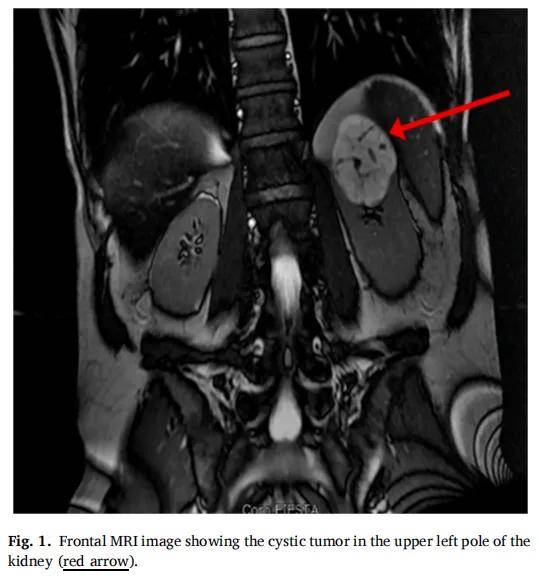 高铁蛋白血症入院意外发现肾肿块，检出TFE3基因重排确诊「TFE3重排肾细胞癌」