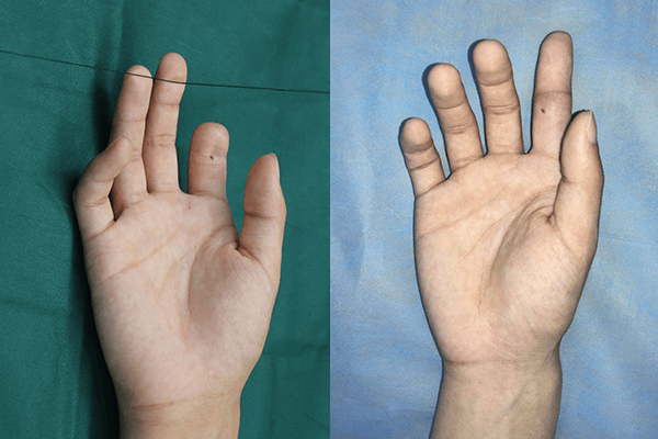 放“心”托付，黄威手指再造中心