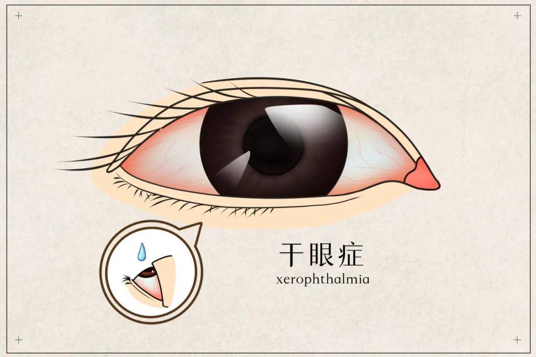 干眼症，不只是“眼睛干”那么简单！