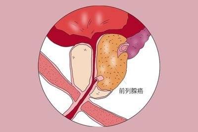 男性前列腺癌饮食要这样吃！拒绝脂肪才是上策