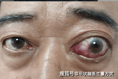 甲状腺与免疫系统：健康的“共生与博弈”