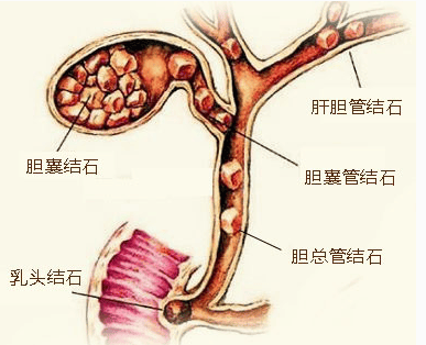 一分钟小课堂：和肝内胆管结石说拜拜的预防法
