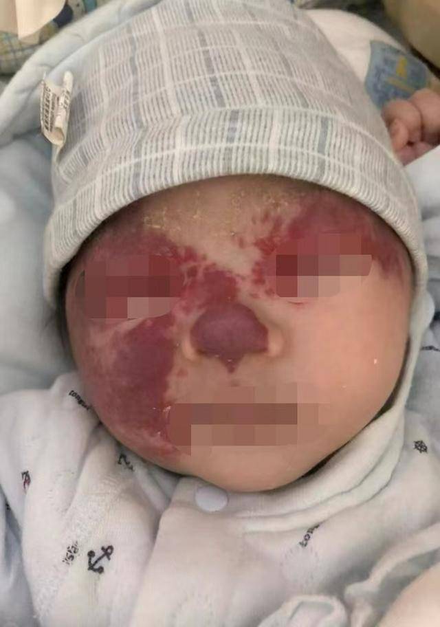 宝宝红色胎记长脸上，医生“施魔法”五年后胎记消失了！