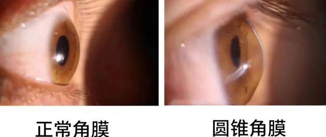 昆明艾维眼科角膜移植手术助20岁小伙重返清晰视界