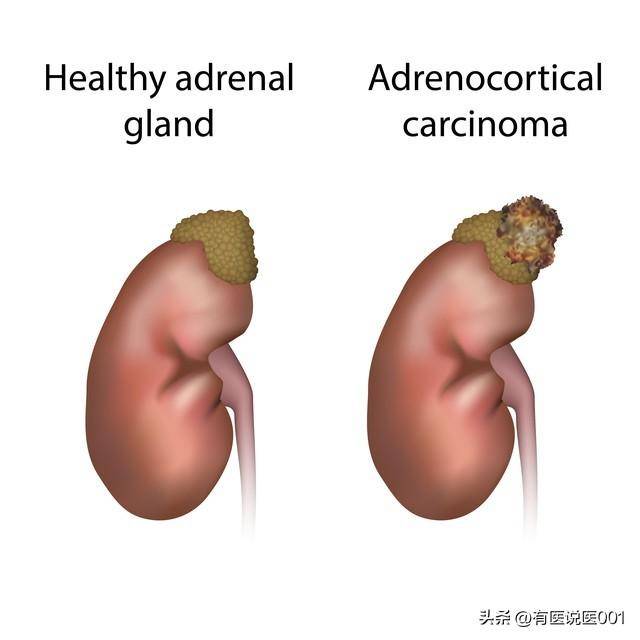 体检查出肾囊肿别慌！根源在2滞2虚，中医通补结合调，看懂少焦虑
