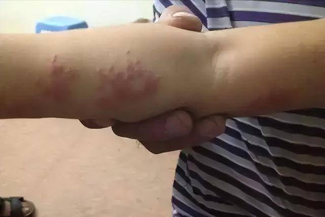 人不会无缘得带状疱疹？医生直言：患带状疱疹，背后有4个原因