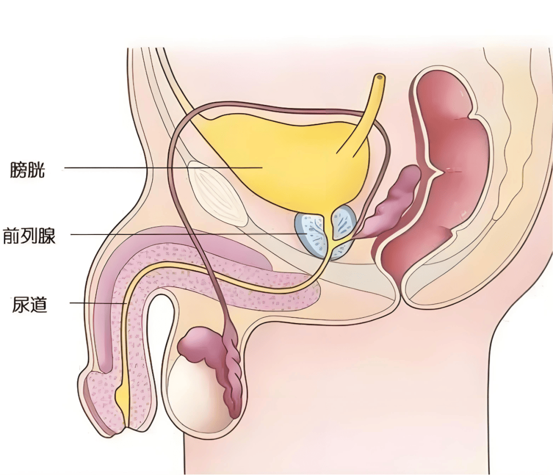 前列腺癌治疗：科学应对，守护男性健康
