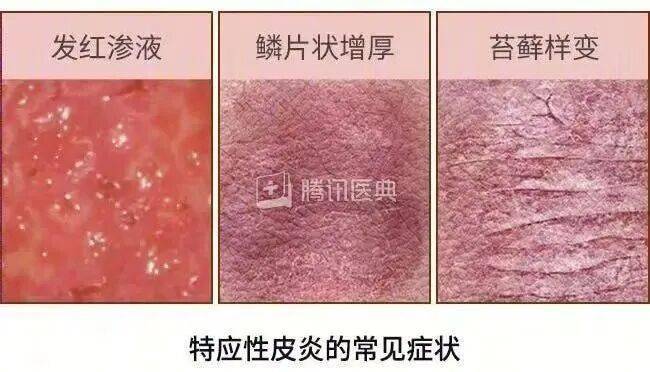 冬季湿疹高发，到底要“祛湿”还是“保湿”？