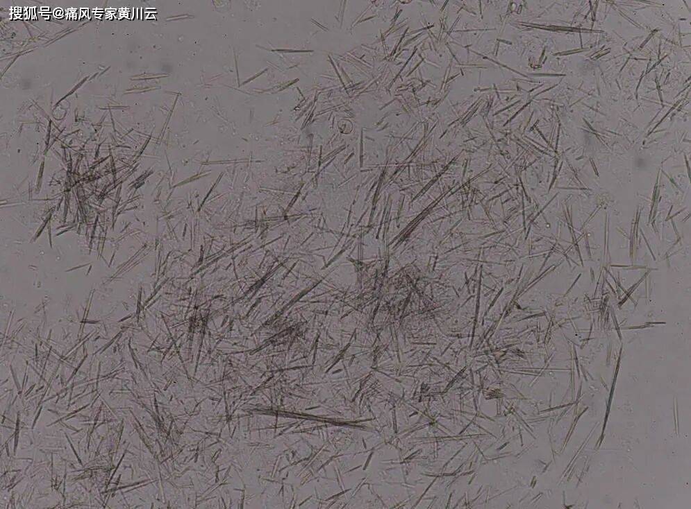 尿酸结晶堵关节、伤肾脏？4个天然“融晶招”，在家就能溶解排出去！