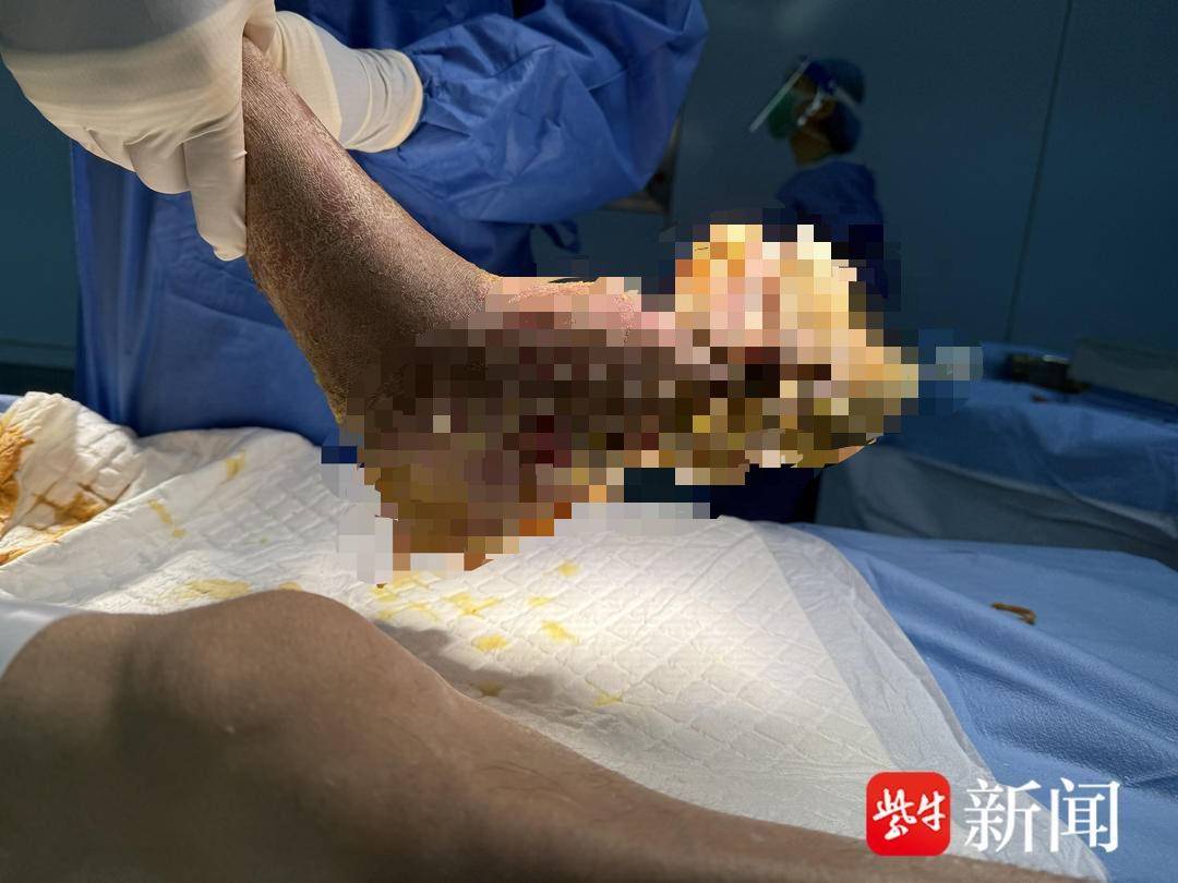 男子喜欢抠脚，结果脚上长满“菜花”，确诊HPV，医生提醒