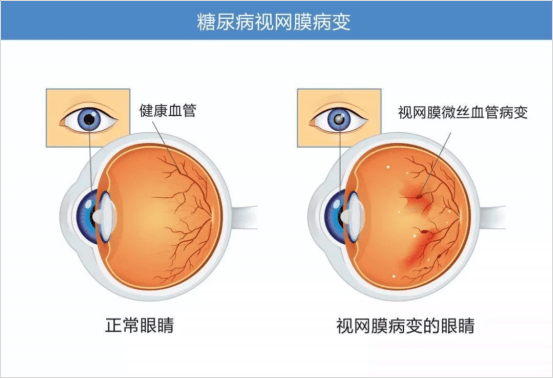 糖友警惕！这项检查不能漏