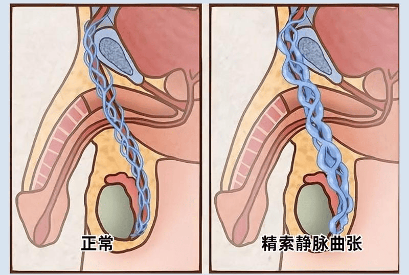 精索静脉曲张和下肢静脉曲张：看似相似，原理大不同