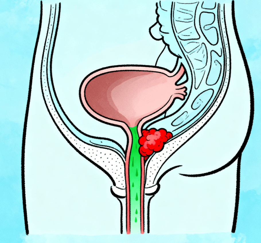 中老年男同胞注意：夜尿多、排尿难？别忍！可能是前列腺在 “求救”