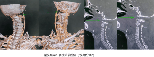 惊心动魄！60岁老人因意外“头颈分离”直送ICU，经广州医生抢救获重生