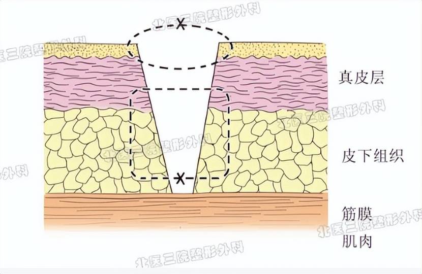 “美容缝合”是不需要拆线的缝合吗？