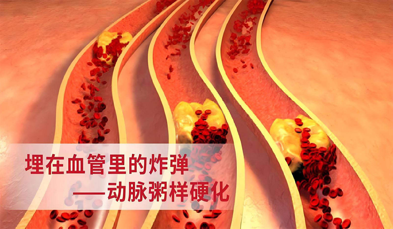 张景龙医生：动脉粥样硬化的症状表现和治疗方法