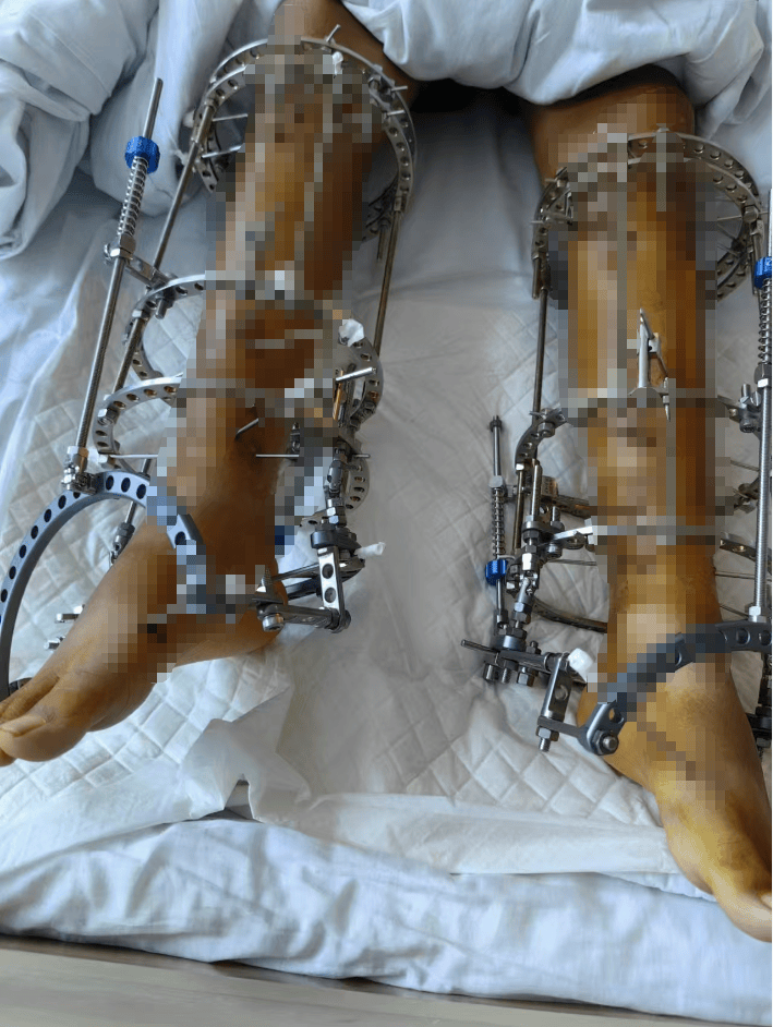 “断骨增高术”后的他们：难修复的长短腿、疼痛无力等后遗症，以及无尽的后悔