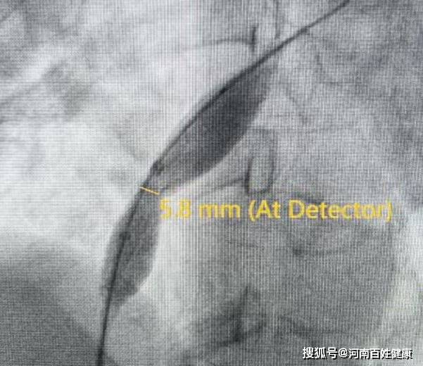 反复头痛查不出原因？可能是心脏有“洞”！