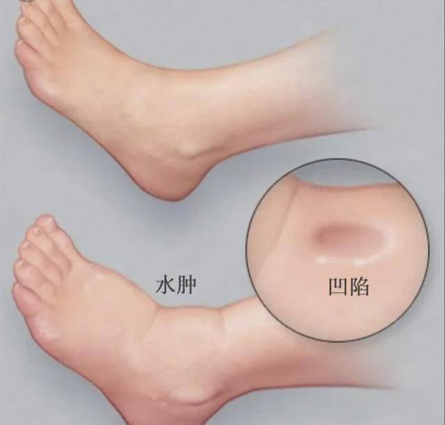 身体自带2个“排水开关”！阴陵泉+水分穴，健脾祛湿消水肿